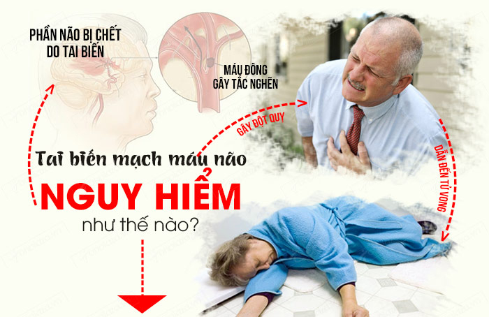 Tai biến mạch máu não là căn bệnh nguy hiểm